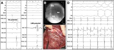 A porcine large animal model of radiofrequency ablation-induced left bundle branch block